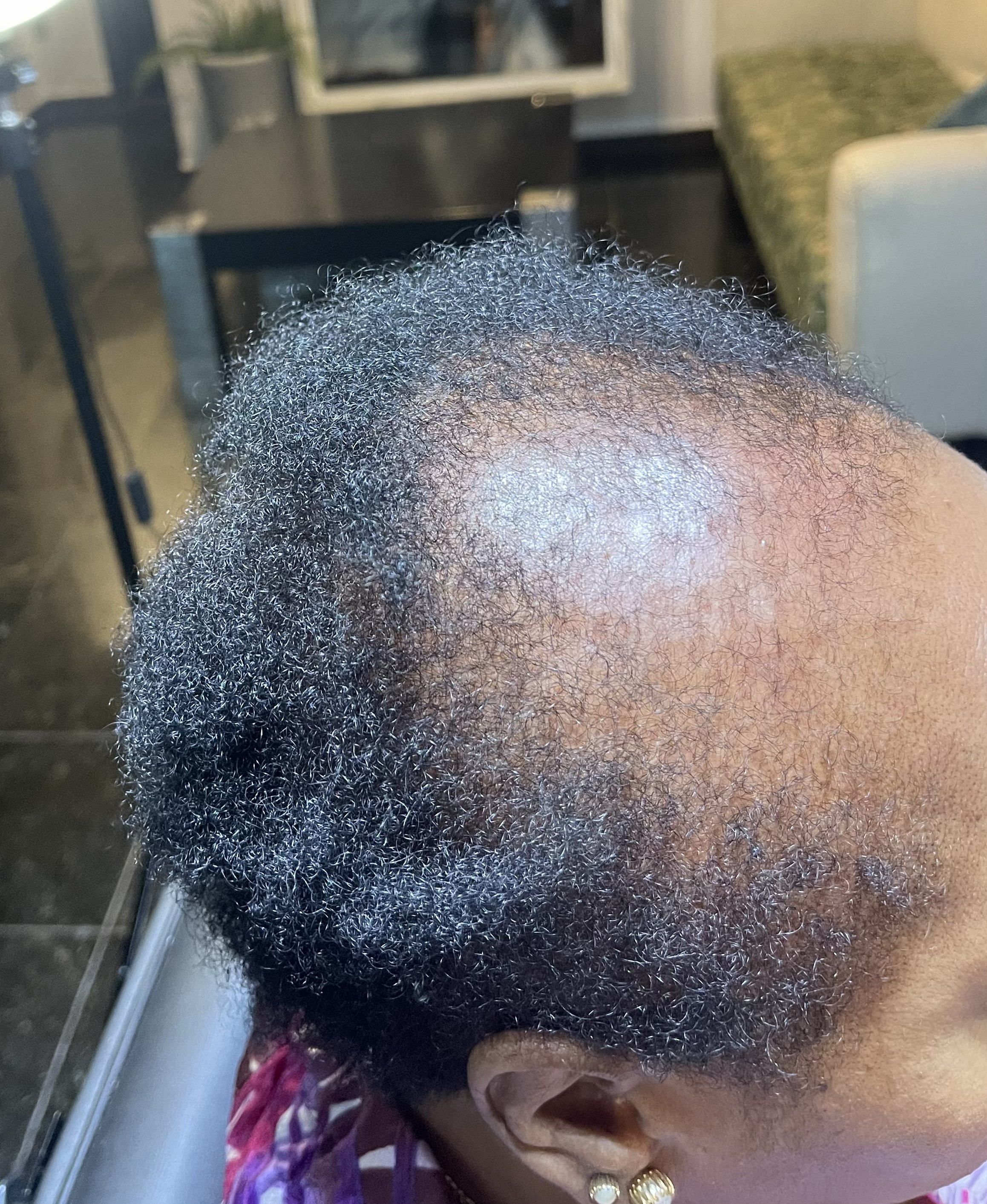 Alopecia 2